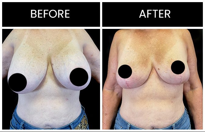 Atlanta Breast Implant Removal Results